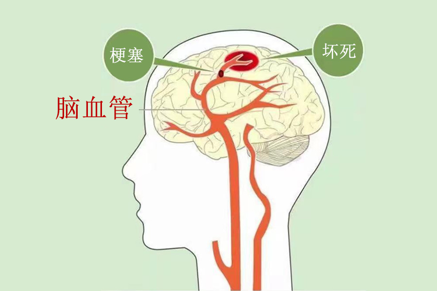 丹清健康产业：脑血栓与脑栓塞的区别